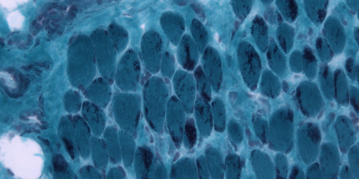 Evolution Virtual Lab Diagnostic Gene Hotspot Found in a Rare Childhood Muscle Disease | Genetics