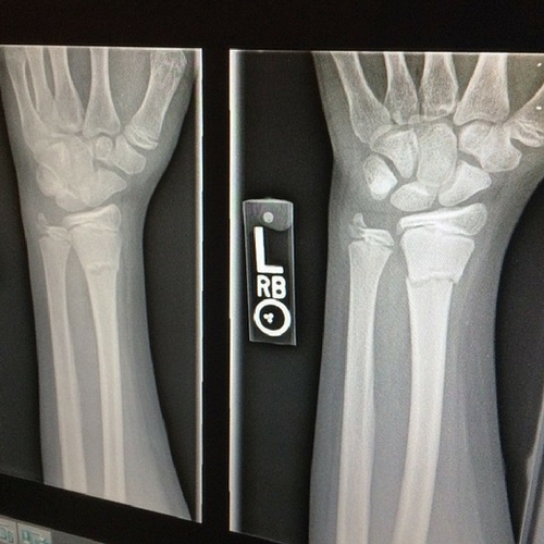 Growing Bones in the Lab Health And Medicine