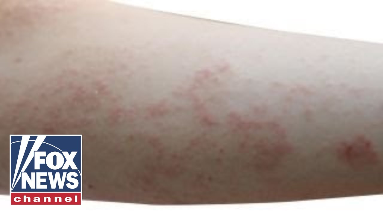 Can Scabies Be Deadly? Videos