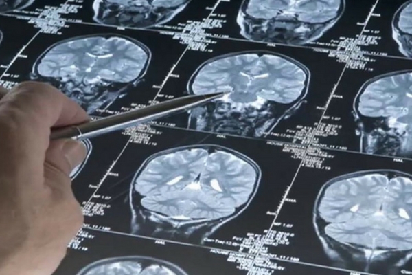 Mris Predict Which High Risk Babies >> Can Brain Imaging Predict Autism Risk Neuroscience Mris Predict Which High Risk Babies >> Can Brain Imaging Predict Autism Risk Neuroscience