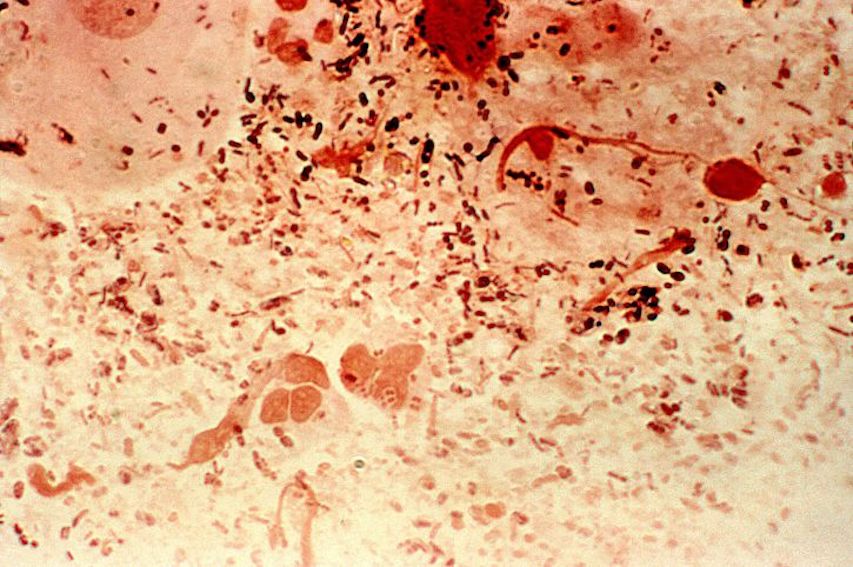 Untreatable Gonorrhea on the Rise Microbiology