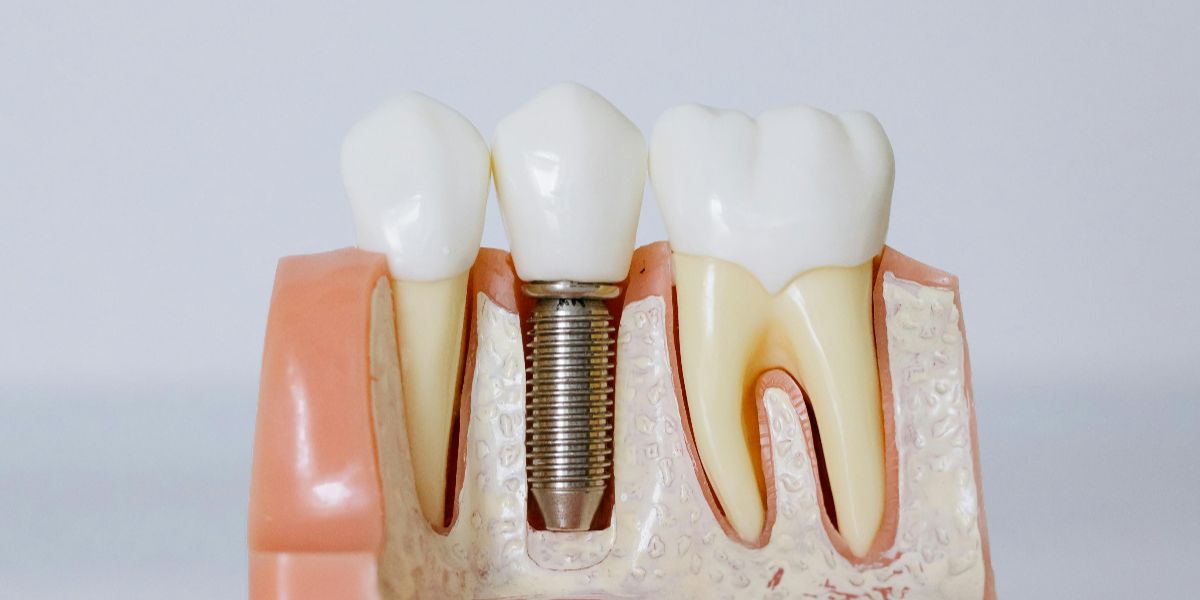 Gum Disease Linked to Brain White Matter Damage | Neuroscience