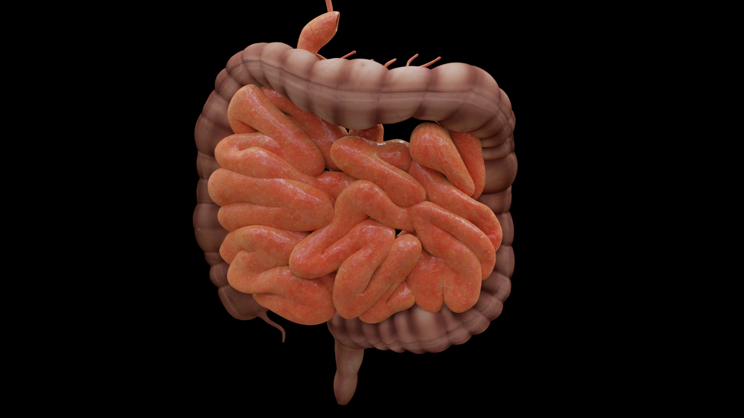 Generative AI Helps Spot Crohn's Bowel Scarring Early