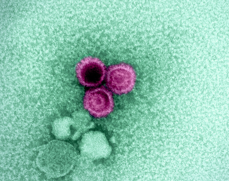 A Surprising Link Between Epstein-Barr Virus & Crohn's is Revealed