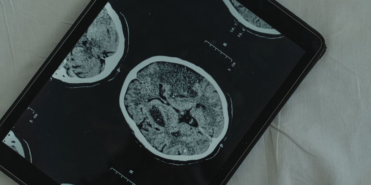 Stroke Rates Nearly Double Among Younger Adults