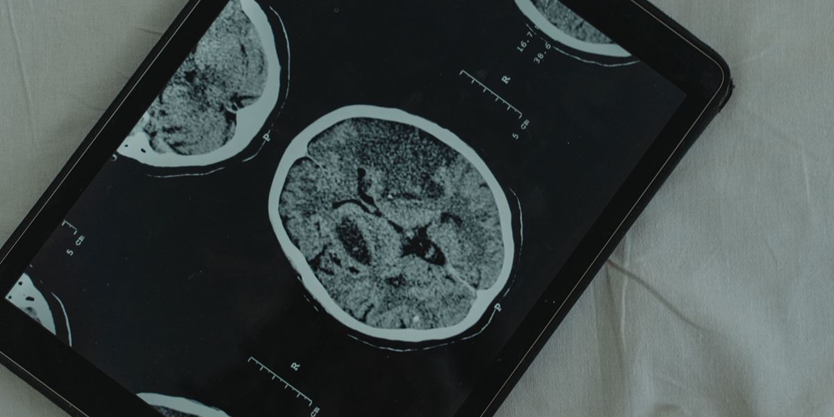 Modifiable Risks Linked to Dementia-Related Brain Damage