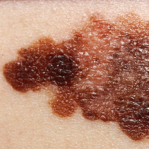 Study Reveals a Hidden Gene Target For Melanoma | Cancer