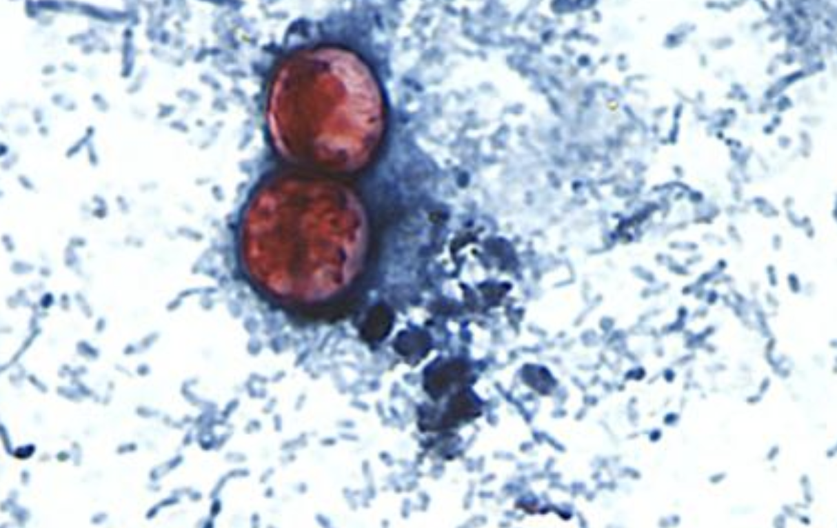Cyclosporiasis: This Parasitic Illness is Causing an Explosive Problem